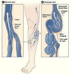 足のむくみと疲労を伴う病気 下肢静脈瘤